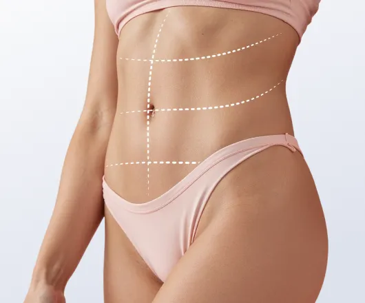 extended tummy tuck
