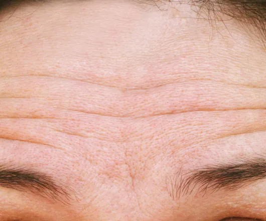 forehead lines