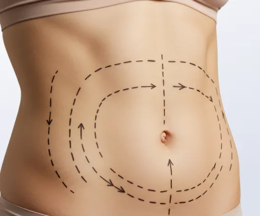 full tummy tuck