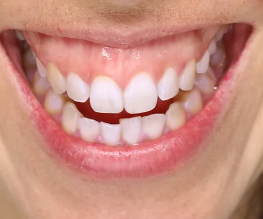 gummy smile