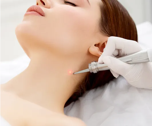 laser mole removal