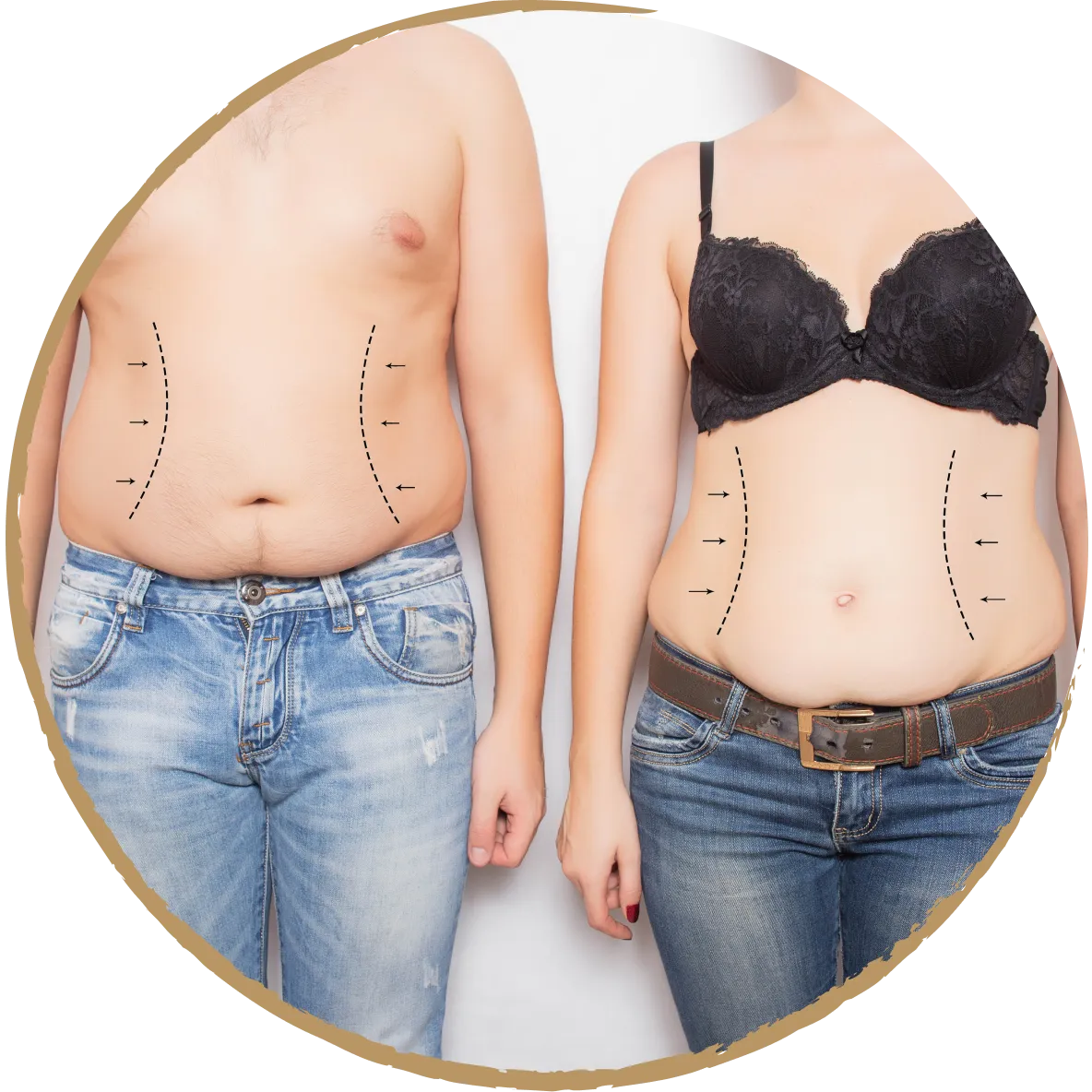 liposuction 01