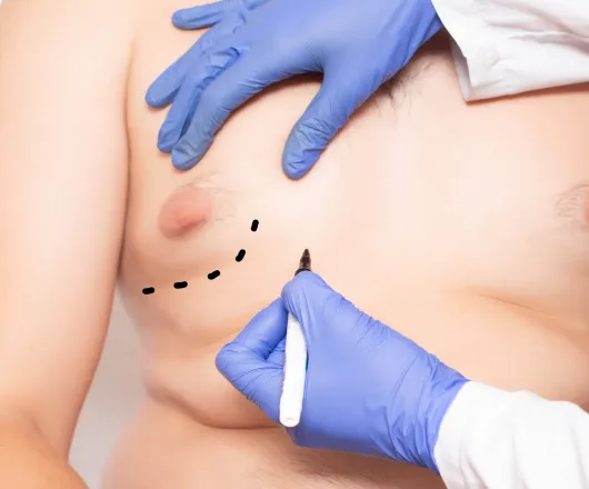 liposuction alone