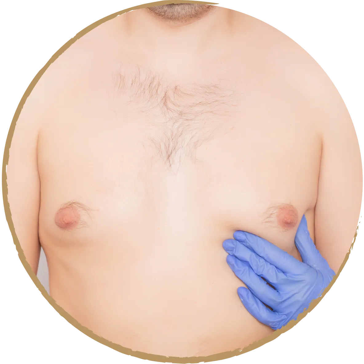 male breast 01
