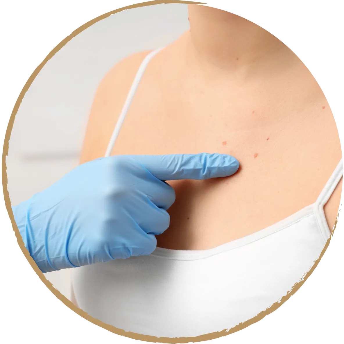 mole removal 01