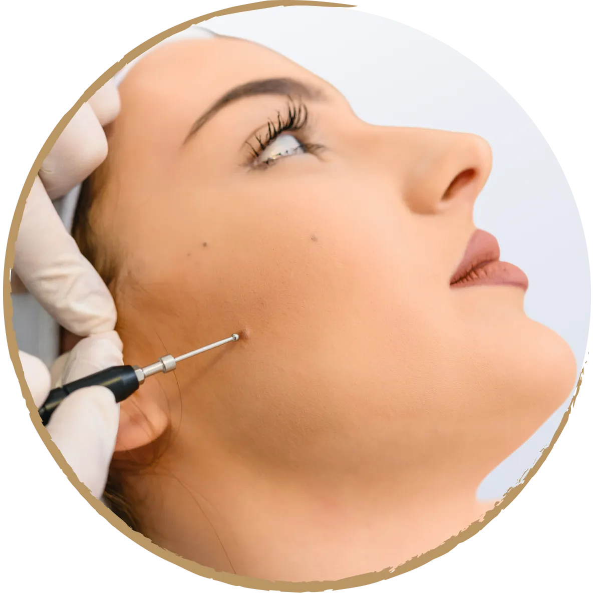 mole removal 02