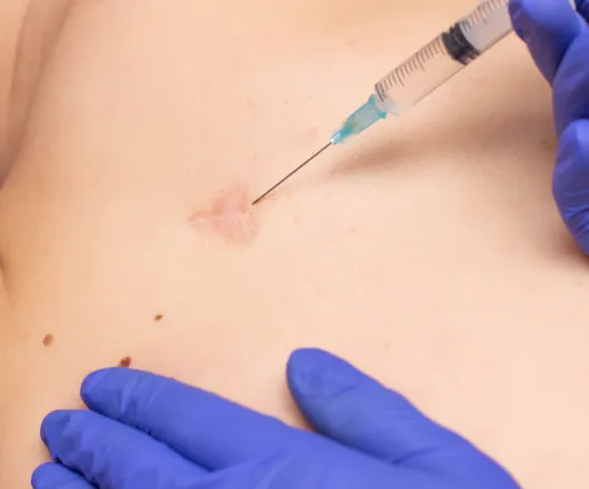 steroid injections