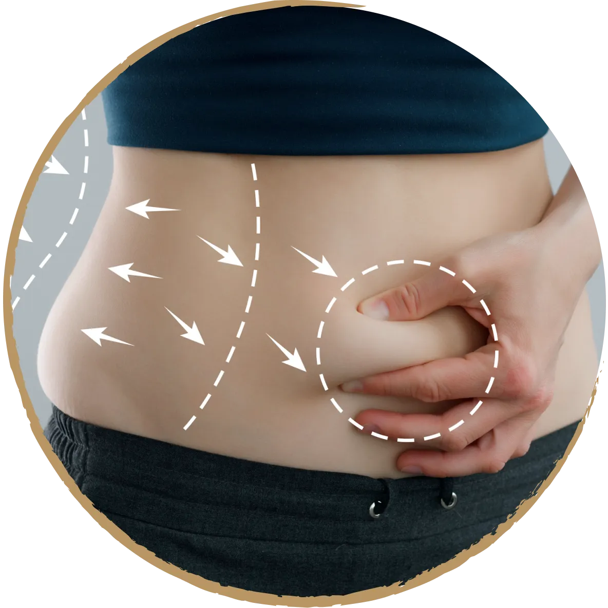 tummy tuck 01