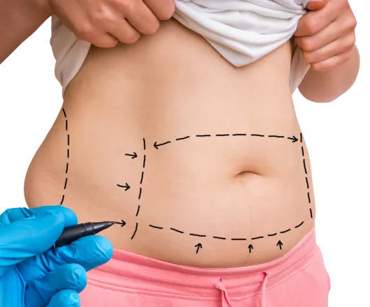 tummy tuck