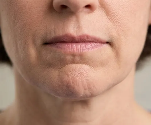 chin dimpling