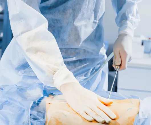 liposuction
