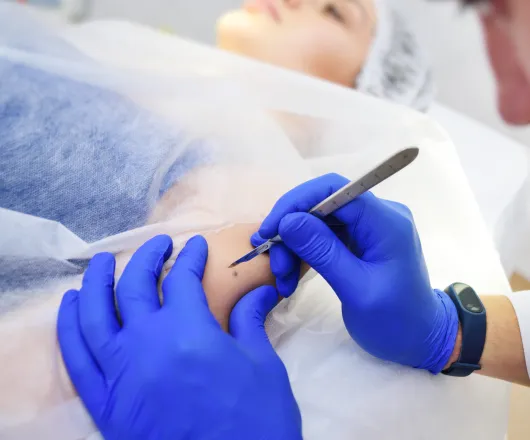 surgical excision
