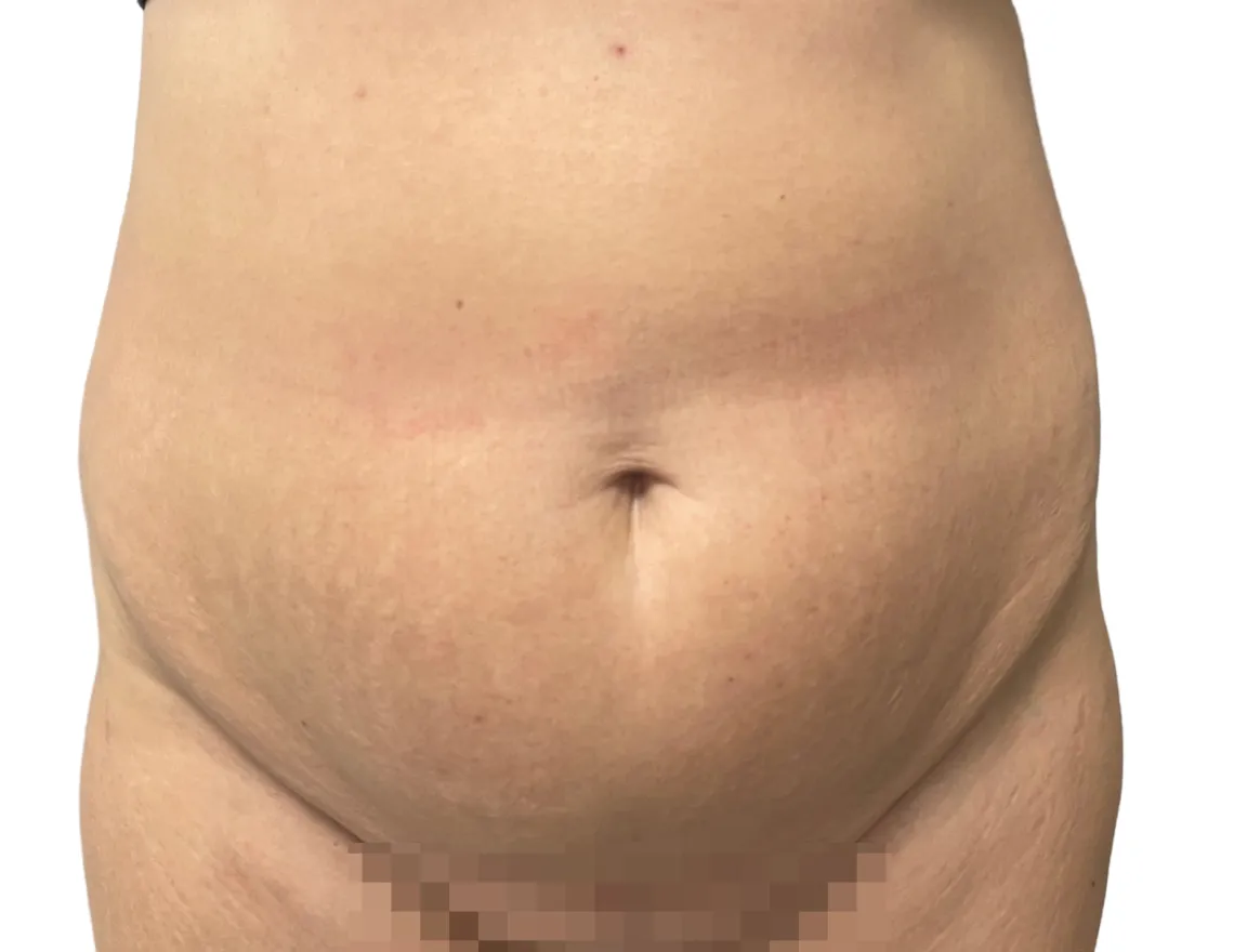 tummy tuck before