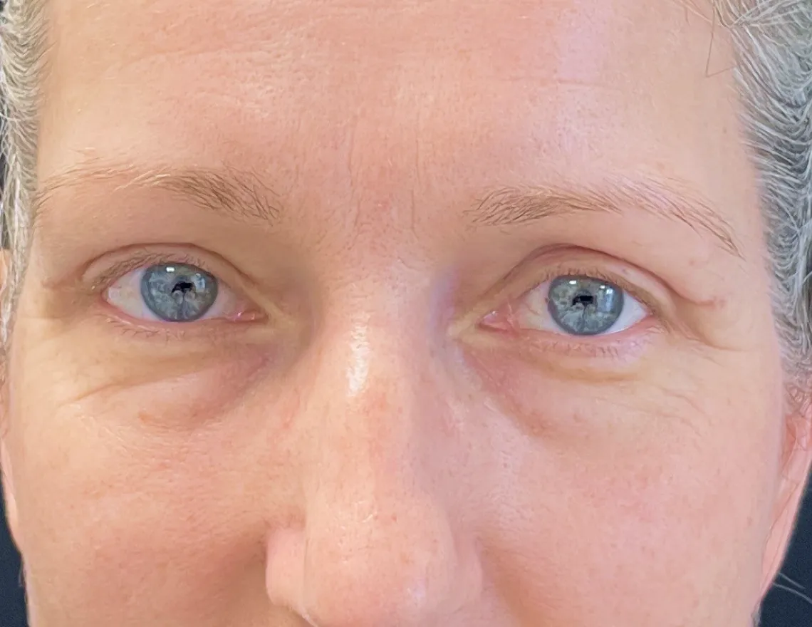 upper eyelid after