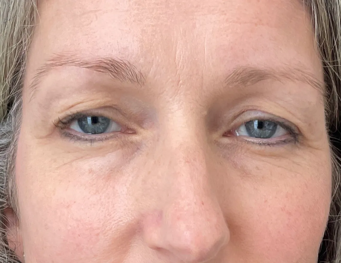 upper eyelid before