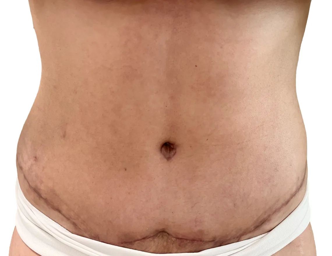 utummy tuck after